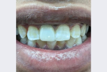 After Post and Core