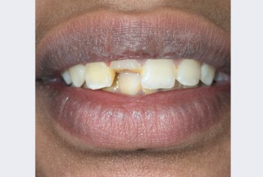 Before Post and Core
