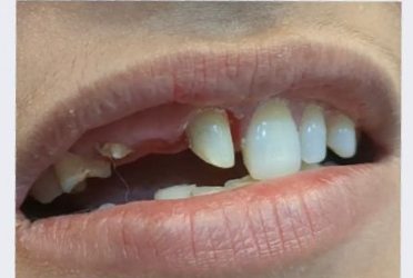 Before Smile Transformation