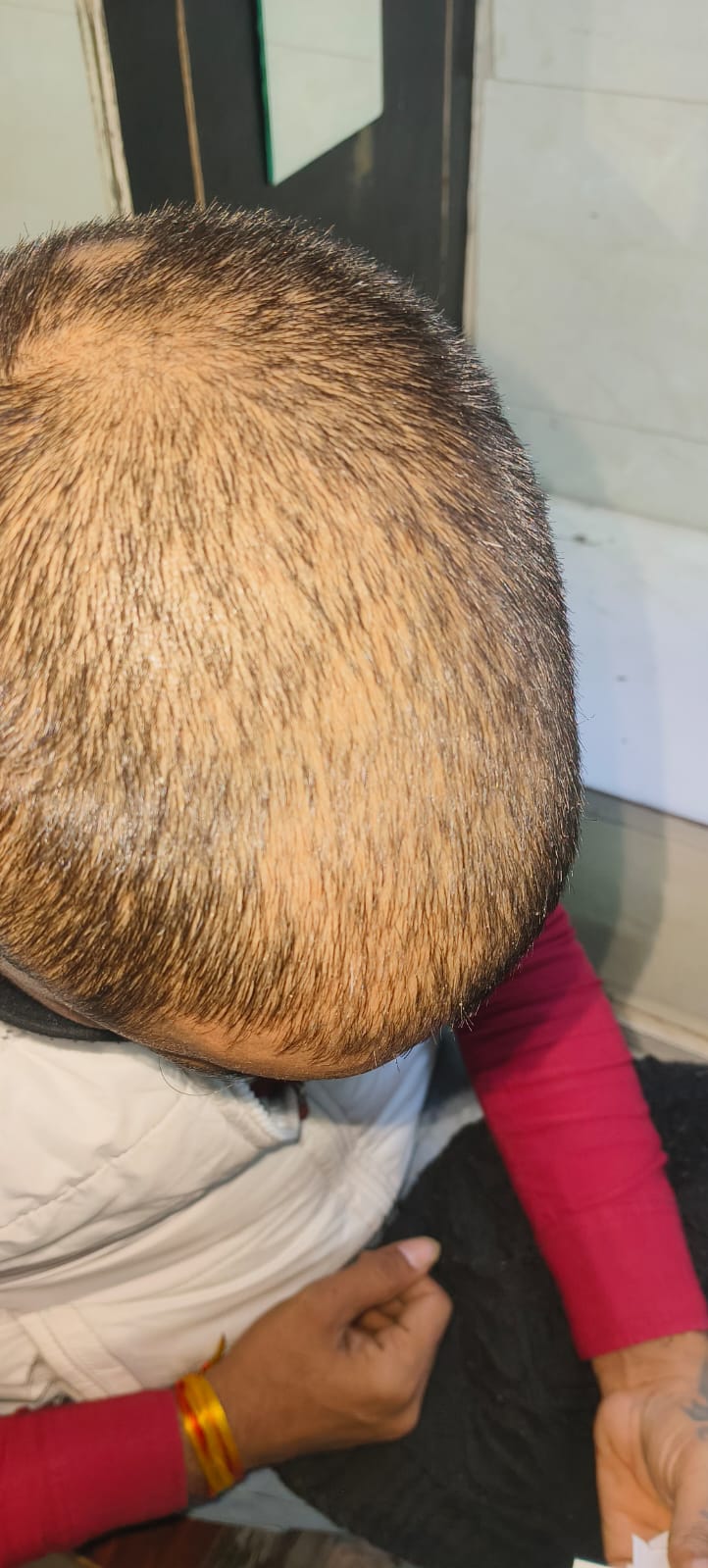Hair Loss