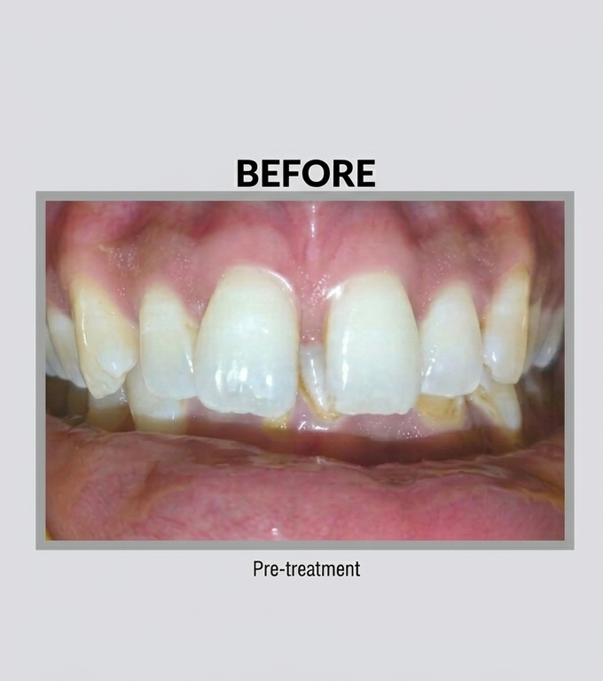 Before Diastema Closure