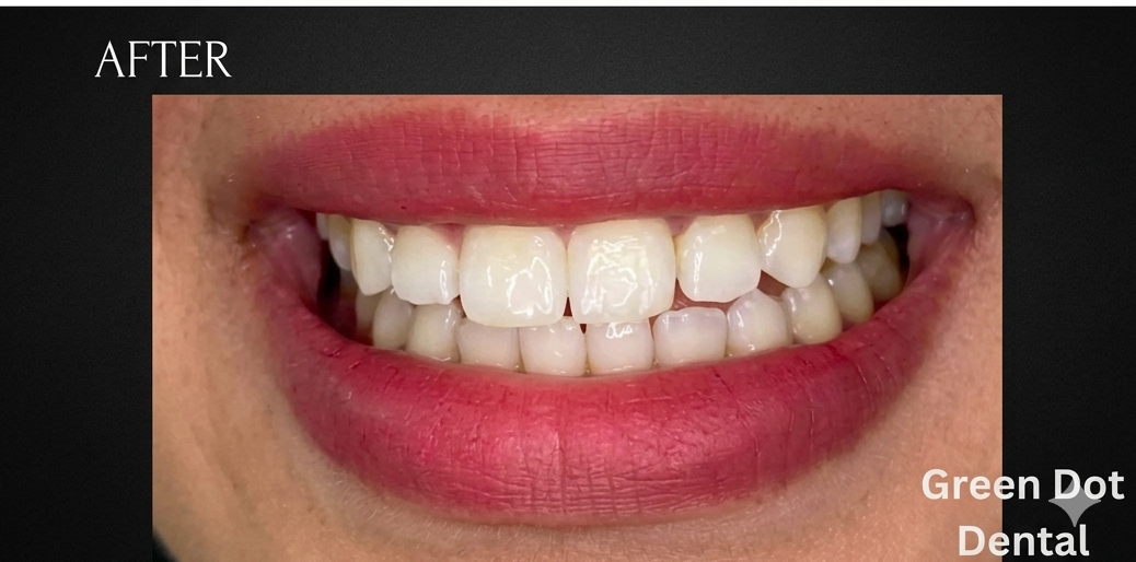 After Whitening